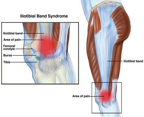 Iliotibial Band Syndrome