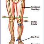 back pain caused by feet