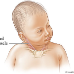 Congenital Muscular Torticollis