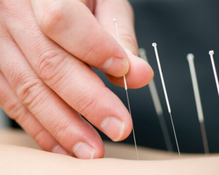 acupuncture treatment