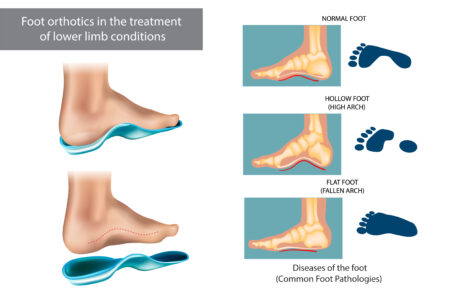 An illustrated diagram titled 'foot orthotics in the treatment of lower limb conditions.' The illustrations on the left show a foot placed inside a custom orthotic and another image showing how the arch of the foot aligns with the custom orthotic.
The illustrations on the right show the arch of a normal foot, the arch of someone with hollow feet (high arches) and the arch of someone with flat feet (no arch/fallen arch).