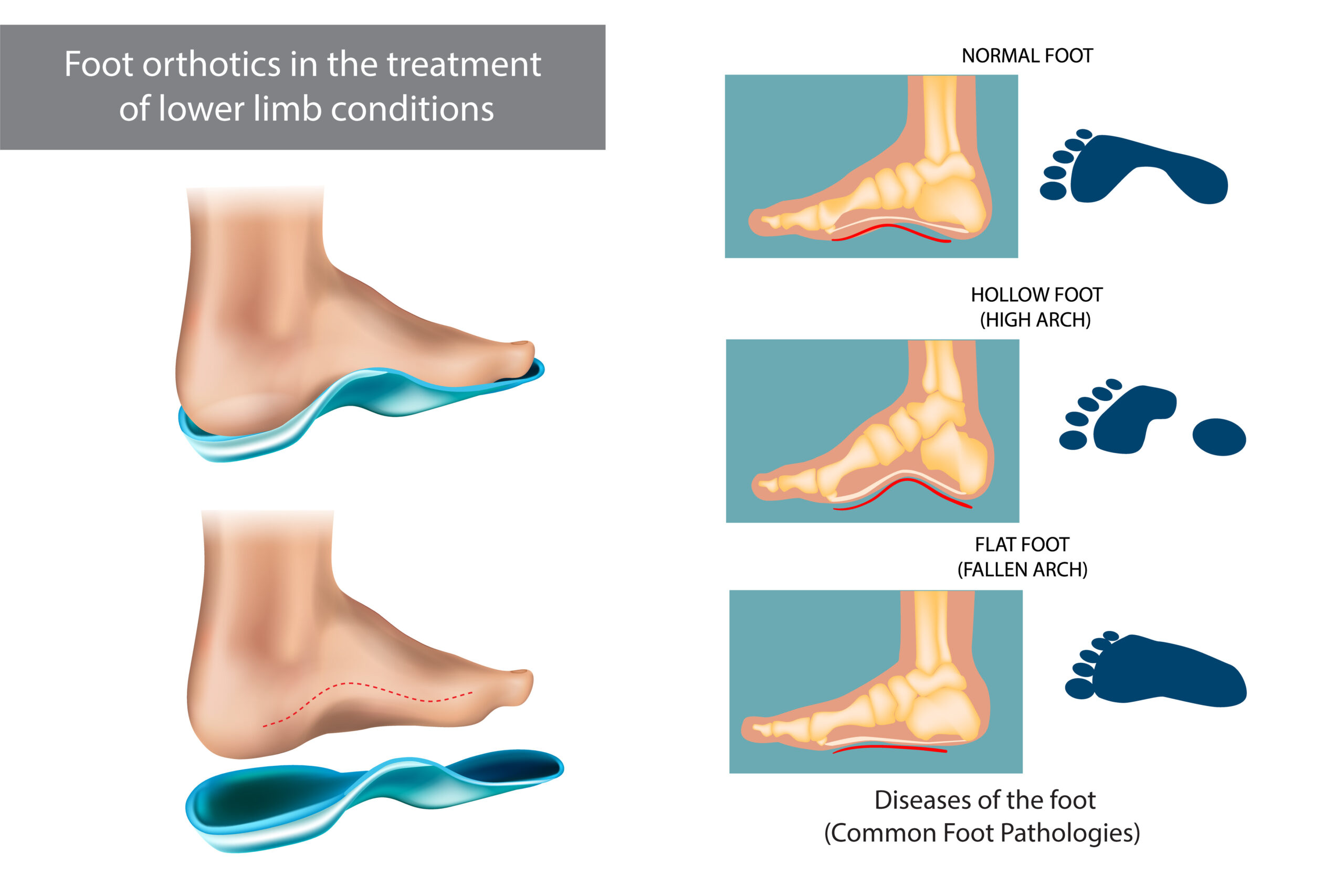 What Are Custom Foot Orthotics?: Benefits, Types, Cost, & More