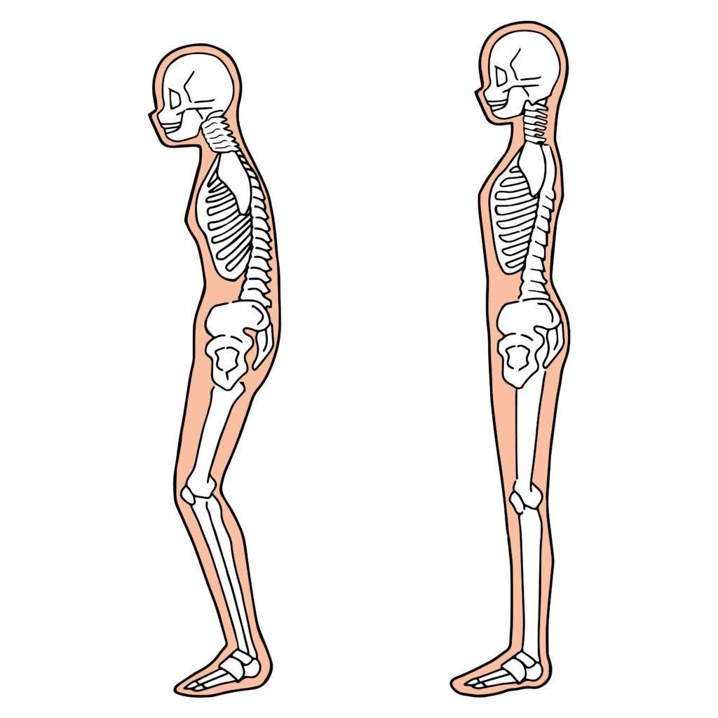 An illustration showing two skeletons. The skeleton on the left has a bent spine and the skeleton on the right has straight posture.