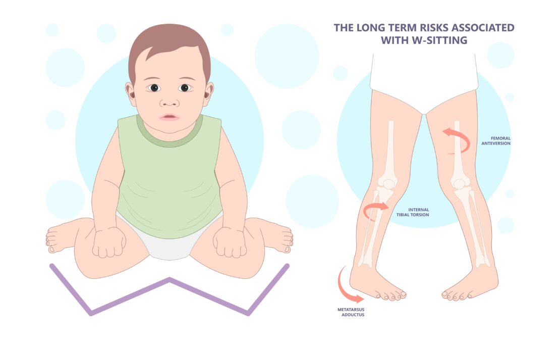 The illustration on the left shows a child sitting on his knees, legs splayed in a "W" shape. This is known as "W-Sitting." The diagram on the right shows the long-term risks associated with W-Sitting, including femoral anteversion, internal tibial torsion, and metatarsus adductus